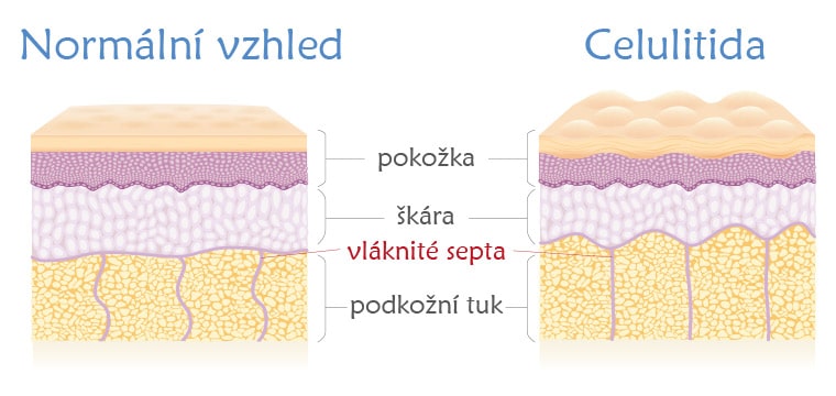 Jak vzniká celulitida